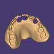 Clipboard-2024-12-21-00-26-06.jpg DIGITAL FLEXIBLE UPPER PARTIAL DENTURE  (3D models !!!) - 7 stl files for download)