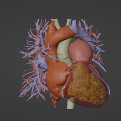 1.png Modèle 3D d'un cœur humain présentant un drainage veineux pulmonaire anormal (DVPA) - généré à partir d'un patient réel