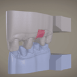 Screenshot_1.png Digital Implant Model with Soft Tissue