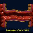 ps10.jpg 3D Angiogenesis NEW BLOOD VESSEL FORMATION