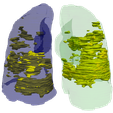 3.png 3D Model of Lungs Infected with Covid19