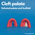 Cleft-Lip-Palate.png 👄 Cleft palate | Defected palate and scaffold for reconstruction 👄