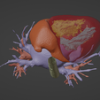 6.png 3D Model of Human Heart with Hypertrophic Cardiomyopathy - generated from real patient