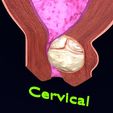 cerv0003.jpg Útero normal frente a tipos de fibromas 3d set
