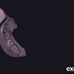 exocad model scanning vs. impression scanning for implant prosthetics