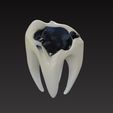 caries1.jpg 龋齿