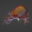 6.png 3D Model of Human Heart with Co-Arctation (CA) - generated from real patient