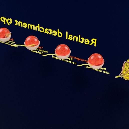 retinal-detachment-types-eye-3d-model-blend-78.jpg Retinal detachment types eye 3D model