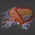 6.png Model of human heart with pulmonary atresia (PuA) - generated from real patient