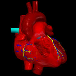 1.png Modèle 3D d'une connexion veineuse pulmonaire anormale partielle