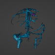 w22.png 3D Model of Brain Arteriovenous Malformation