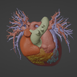 5.png 3D Model of Human Heart with Pulmonary Artery Sling (PAS) - generated from real patient