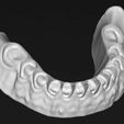 low1.jpg Digital total dentures