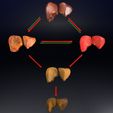 ps19.jpg 3D Alchoholic liver disease cirrhosis hepatitis fatty model