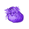 STL.stl 3D Model of Human Heart with Interrupted Aortic Arch (IAA) - generated from real patient