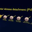 posterior-vitreous-detachment-types-eye-3d-model-blend-48.jpg Posterior vitreous detachment types eye 3D model