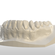 Screenshot_25.png Digital Full Coverage Occlusal Splint with Canine Guidance