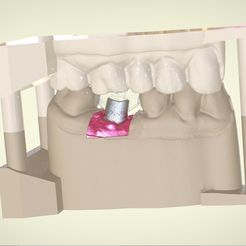 Snapshot_2017-2-10_20-44-30.jpg STL file Digital Implant Model with Positioning Guide・3D printing model to download