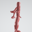 p3.png Case 1 to 6: 3D aortic and iliac artery aneurysm