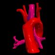 4.jpg 3D Model of Double Aortic Arch