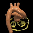 17.png 3D Model of Transposition of the Great Arteries Open Duct