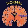 ps11.jpg Alzheimer Disease Brain coronal slice