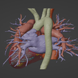 4.png 3D Model of Human Heart with Transposition of Great Arteries (TGA) - generated from real patient