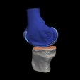 4.png 3D Model of Knee - generated from a real patient