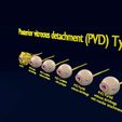 posterior-vitreous-detachment-types-eye-3d-model-blend-53.jpg Posterior vitreous detachment types eye 3D model