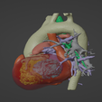 2.png Model of human heart with pulmonary atresia (PuA) - generated from real patient