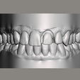 meshmixer_Da1B95cGRQ.png Dental Models for Practice
