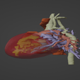 2.png 3D Model of Human Heart with Aortic Arch Hypoplasia (AAH) - generated from real patient