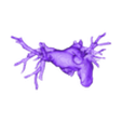 STL00003.stl Modèle 3D de cœur humain avec double arc aortique (DAA) - généré à partir d'un patient réel