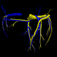 11.png 3D Model of Partial Anomalous Pulmonary Venous Connection