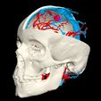 i5.jpg 3D Model of Brain Arteriovenous Malformation