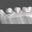 Dental-Training-2.png Training Teeth for Dental Students Black Dental Caries Classification