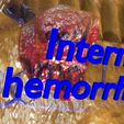 hemorrhoids-piles-3d-model-blend-86.jpg hemorrhoids piles 3D model
