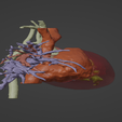 3.png 3D Model of Human Heart with Aortic Arch Hypoplasia (AAH) - generated from real patient