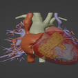 1.png 3D Model of Human Heart with Double Superior Vena Cava (DSVC) - generated from real patient
