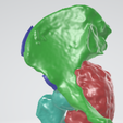 Picture6.png Sarcoma pélvico impresso em 3D e guia de corte 2