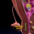 0030.jpg Fibroid Uterus Human female 3D