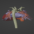 2.png 3D Model of Human Heart with Common Arterial Trunk (CAT) - generated from real patient