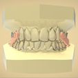 Snapshot_2017-8-30_2-55-57.jpg Digital Elastic Mandibular Advancement Appliance