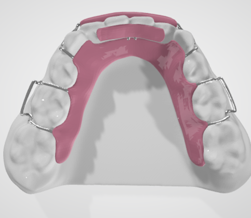 MUSHROOM SPRING ALIGNER DENTAL APPLIANCE
