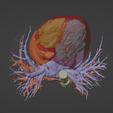 6.png 3D Model of Human Heart with Pulmonary Artery Sling (PAS) - generated from real patient