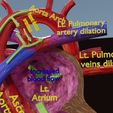 ps-0032.jpg PDA Patent Ductus Arteriosus vs Normal blood circulation