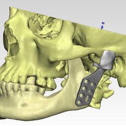 prosthetic-2.jpeg STL file Individual TMJ prosthesis (real operation)・3D print design to download