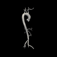 3.png 3D Model of Aorta and Aortic Vessel Tree - generated from real patient