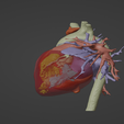 2.png 3D Model of Human Heart with Hypertrophic Cardiomyopathy - generated from real patient