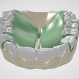 Removable-Palatal-Expansion-Appliance,-molar-distalizer,-teeth,-dental,-tooth,-palatal-expander,-app.png Aparato de Expansión Palatal Removible (KDE) en Dientes Superiores Aparato Dental
